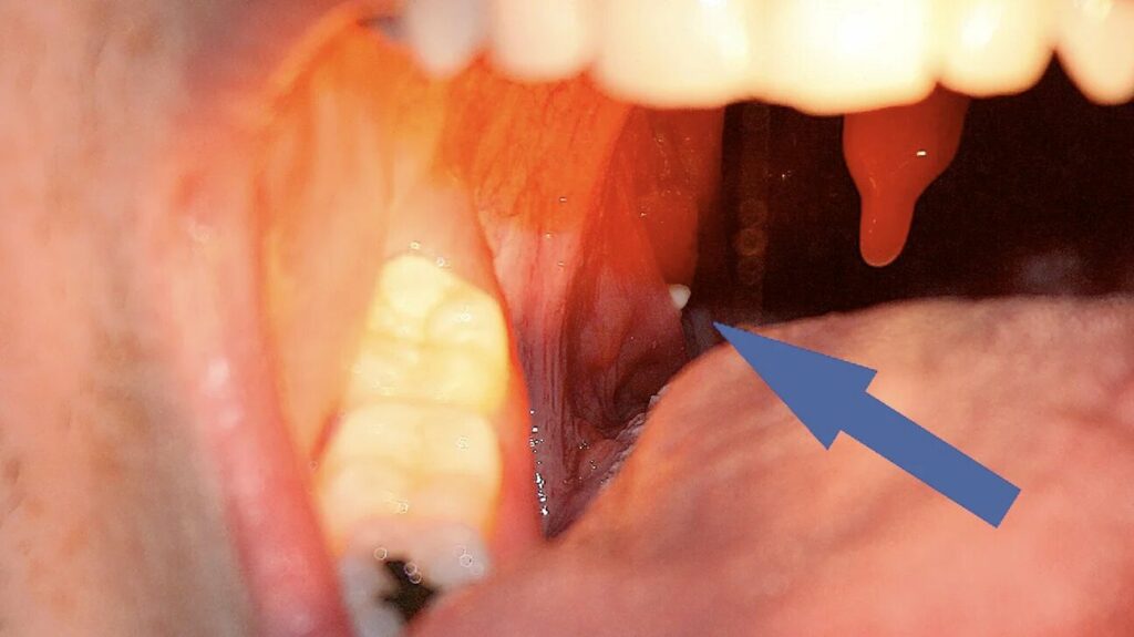 Can Tonsils Grow Back After Being Removed – Take Analysis!