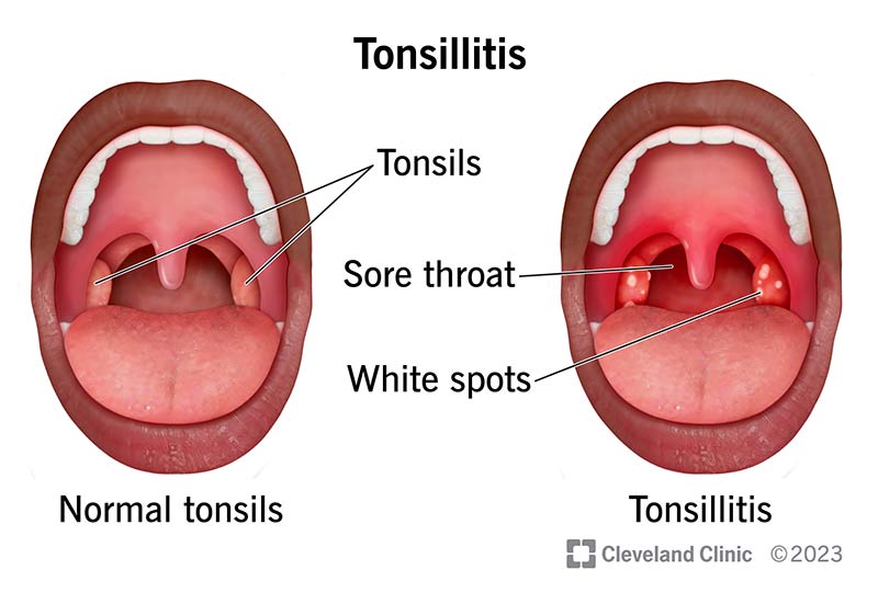 Can You Still Get a Sore Throat If You Don’t Have Tonsils?